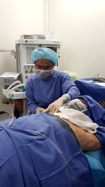 Quy trình Điều trị hôi nách ENDO DRY