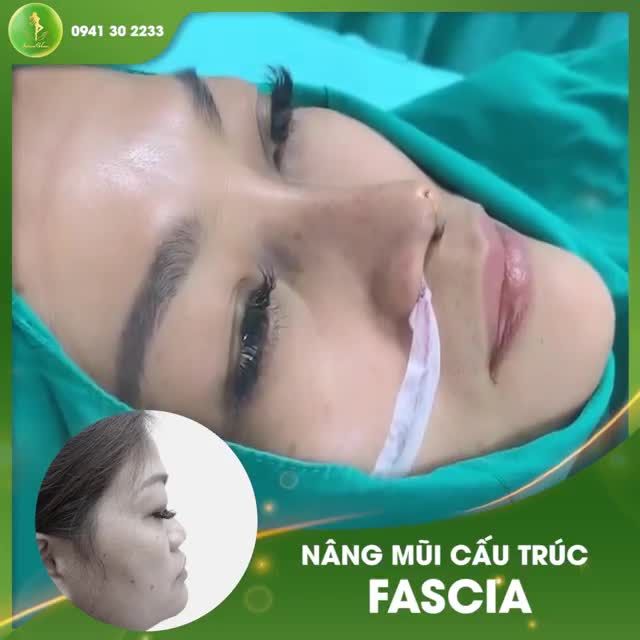 SỐNG MŨI THẤP VÀ NỀN MŨI TO TRỞ NÊN THON GỌN BẤT NGỜ SAU KHI NÂNG MŨI CẤU TRÚC FASCIA