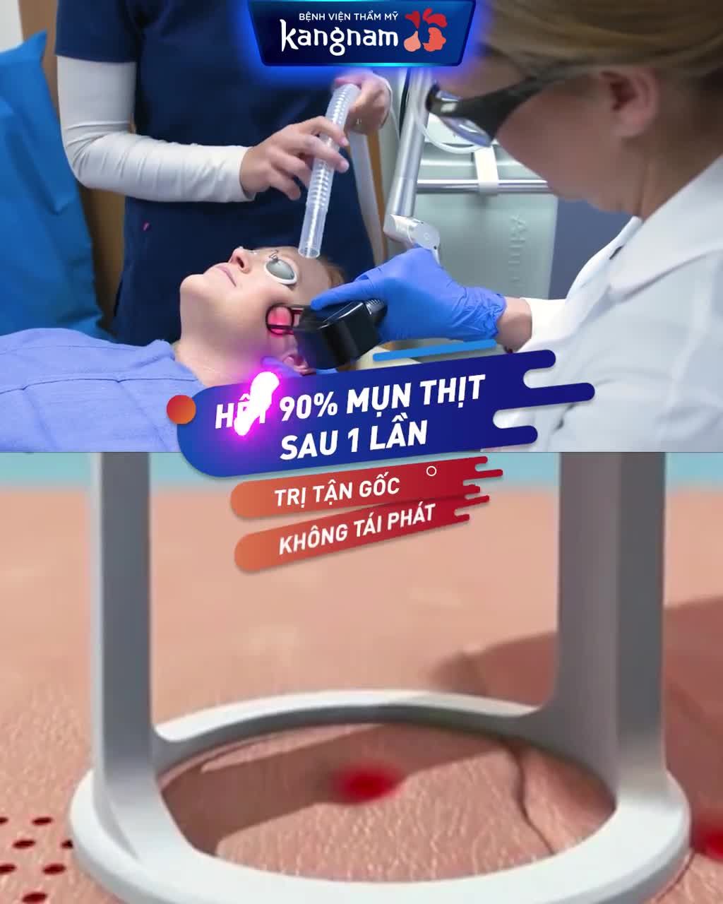 Da sần sùi vì MỤN THỊT ở Mắt/ Má/ Trán/ Cổ?