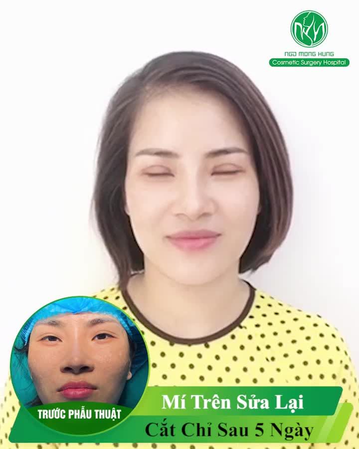 Chị khách quay lại cắt chỉ sau khi sửa lại mí trên tại Bệnh viện Thẩm mỹ Ngô Mộng Hùng.