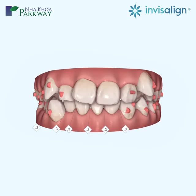 CHỮA RĂNG KHẤP KHỂNH, LỆCH LẠC VỚI KHAY NIỀNG TRONG SUỐT INVISALIGN