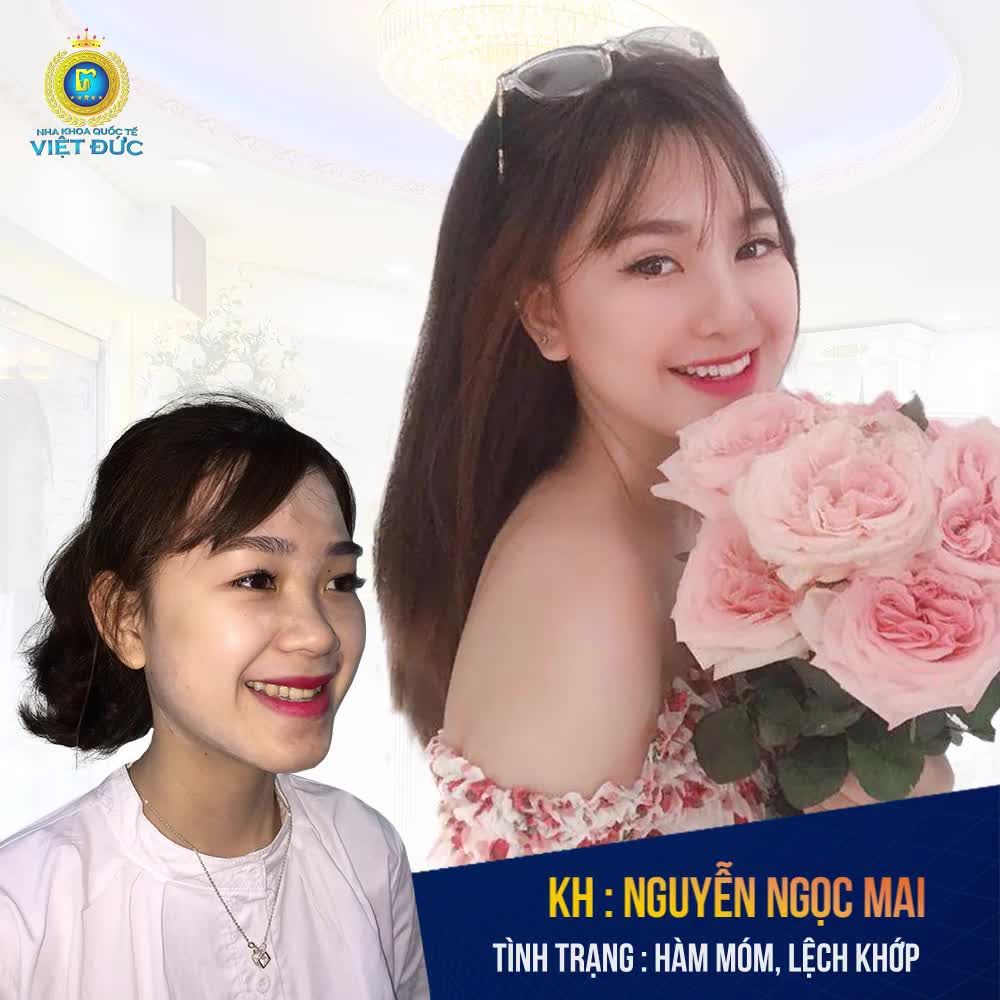 KHẮC PHỤC HÀM HÔ MÓM VỚI CÔNG NGHỆ CHỈNH NHA HIỆN ĐẠI KHÔNG CẦN PHẪU THUẬT XÂM LẤN