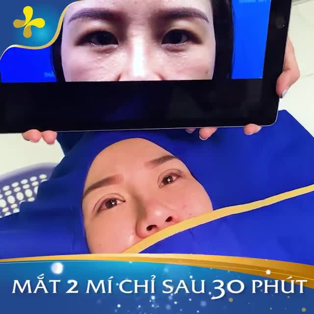 Khách hàng vừa thực hiện nhấn mí tại Dr.Tống Hải. Sau 30 phút đôi mắt một mí của bạn biến thành mắt 2 mí to tròn, cong đều, rõ nét.