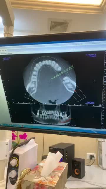 MẤT RĂNG KHẮC PHỤC THẾ NÀO?