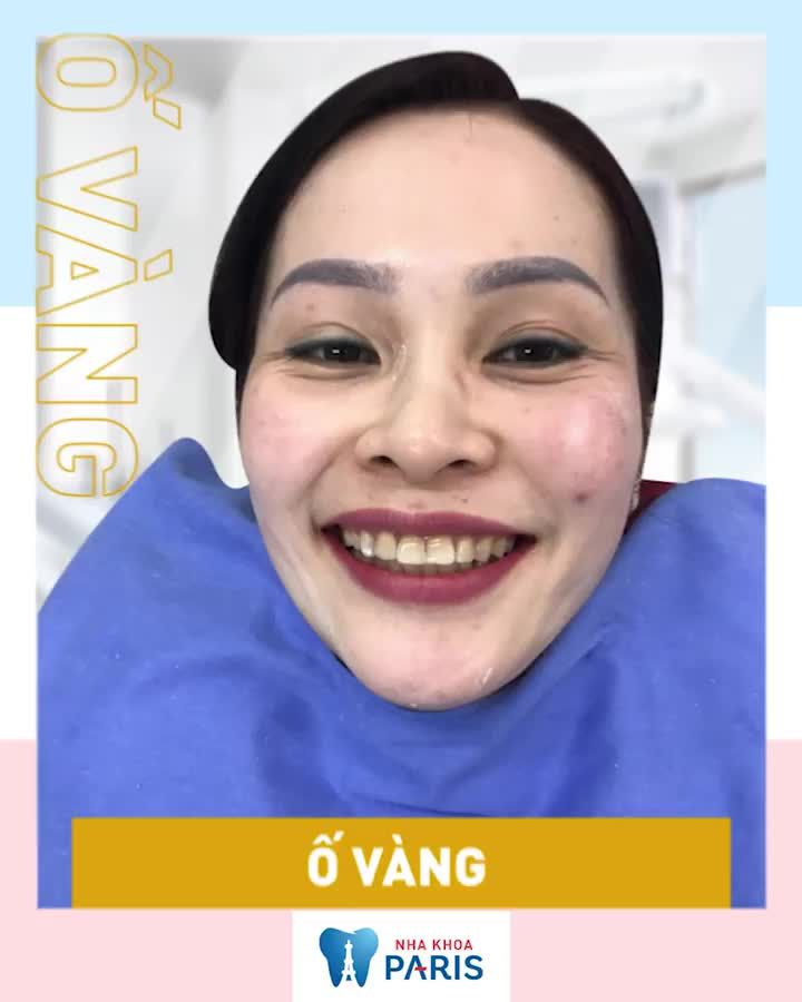 SALE BÙNG NỔ - BỌC RĂNG SỨ -50%