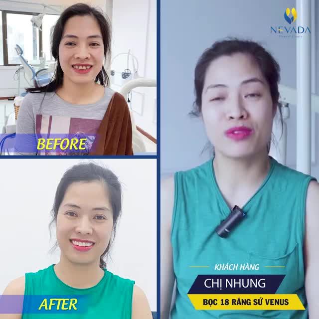 " Sau khi quá trình làm răng đến tận bây giờ thì mọi thứ đều rất hoàn hảo ..." Chị Nhung hạnh phúc chia sẻ khi đến tái khám tại Nevada