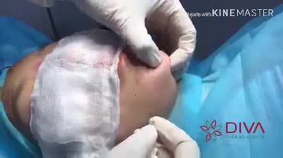 TIÊM FILLER KHÔNG ĐÚNG KĨ THUẬT HẬU QUẢ LÀ GÌ ?