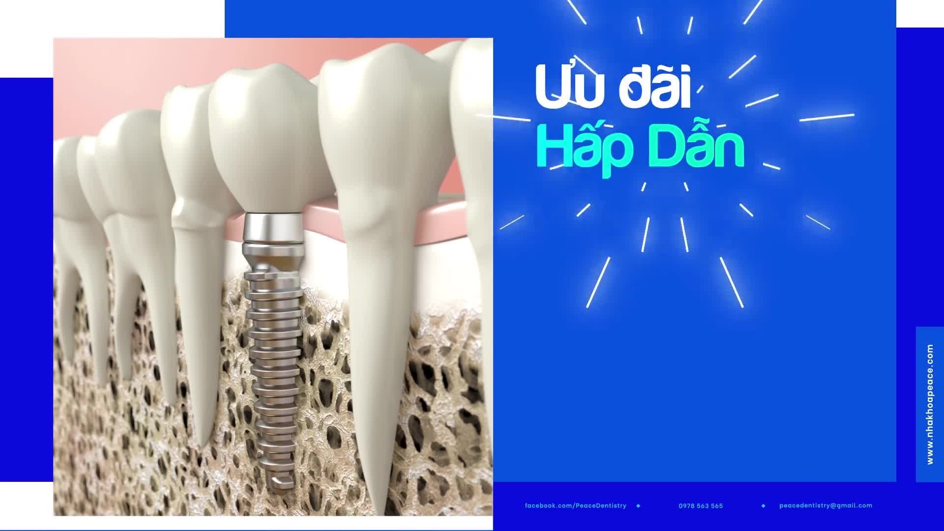 Trồng răng implant cùng bác sĩ chuyên gia tại Peace Dentistry