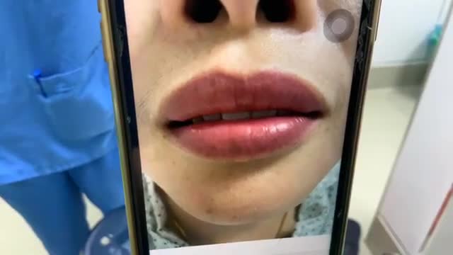Xử trí MÔI trên