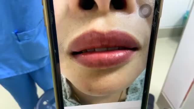 Xử trí MÔI trên