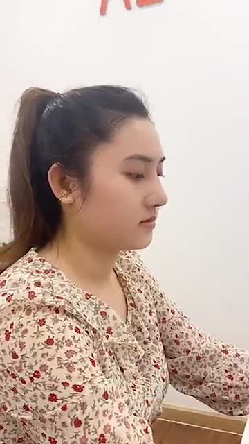 Khách hàng đã nâng mũi tại AZ Nose được 8 ngày vừa cắt chỉ xong.