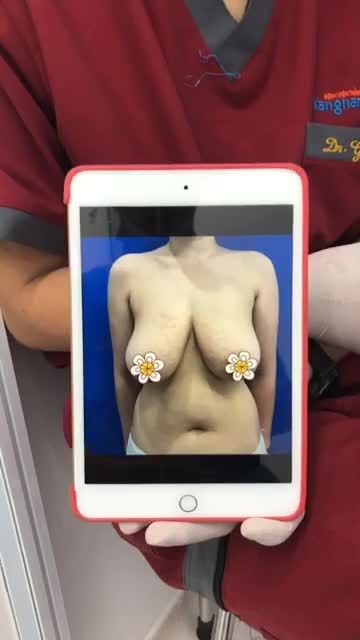 Với trường hợp ngực phì đại và sa trễ độ IV Kangnam sẽ giải quyết như thế nào