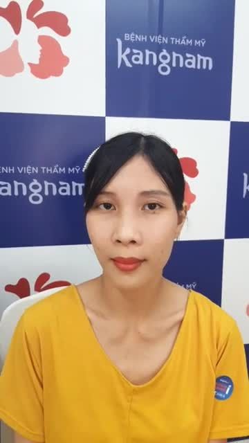 KẾT QUẢ tái khám chỉnh hàm hô trên dưới tại BVTM Kangnam sau 1 tháng phẫu thuật. Kết quả sẽ ra sao?