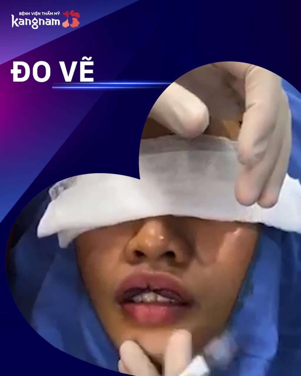 Vừa TẠO HÌNH MÔI mà KHÔNG HỀ SƯNG