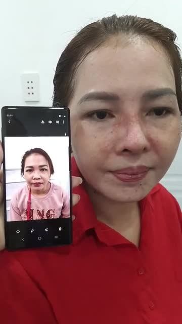 TÁI KHÁM CẮT CHỈ NÂNG MŨI CẤU TRÚC SAU 10 NGÀY