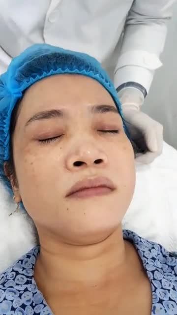 ĐIỀU TRỊ MỤN THỊT CÔNG NGHỆ LASER CO2 VI ĐIỂM!