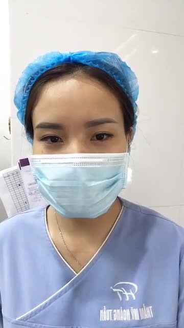 Và chỉ sau 30 phút cắt mí và ghép mỡ đã thay đổi nếp mí của khách hàng.