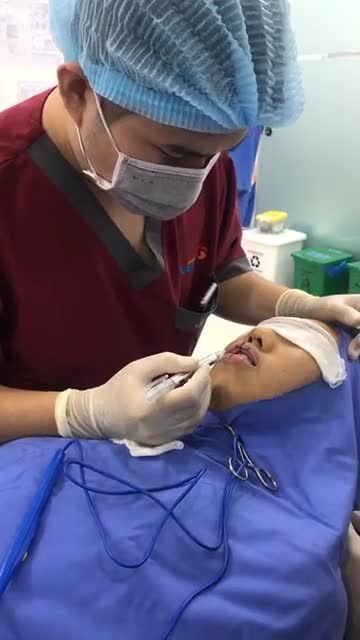 Cùng bác sĩ kiến tạo nụ cười quyến rũ cùng combo Thu mỏng môi trên+ dưới cho vị khách hàng nam