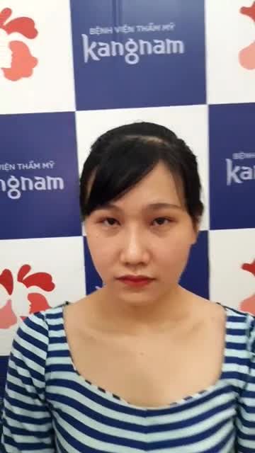 Khách hàng thay đổi hoàn toàn chỉ sau 20 ngày nâng mũi Sline 4D