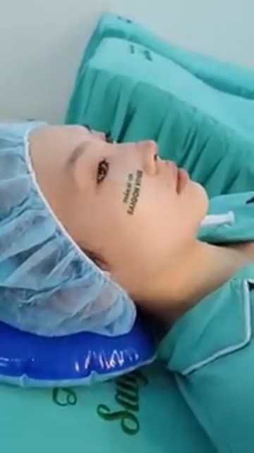 MỘT CA MŨI CẤU TRÚC FASCIAL TẠI SÀI GÒN VENUS
