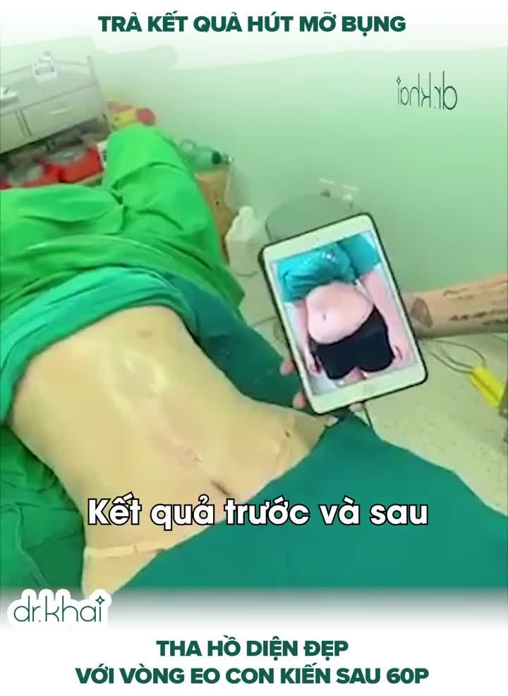 TRẢ KẾT QUẢ hút mỡ bụng của BÀ MẸ 2 CON