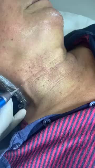Điều trị mụn thịt cổ bằng công nghệ laser Co2 siêu xung không để lại sẹo, không đau rát.
