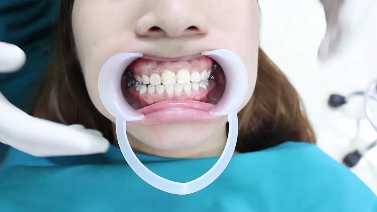 Độ tuổi niềng răng là không giới hạn!