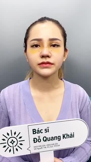 KHÁM PHÁ DÁNG MŨI CẤU TRÚC KẾT HỢP CHỈNH XƯƠNG BÈ TẠI BÁC SĨ KHẢI