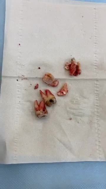 Nhổ răng siêu âm Piezotome hạ gục 4 răng khôn dễ dàng. Cảm nhận thực tế khách hàng