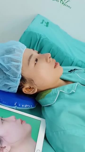 PHƯƠNG PHÁP NÂNG MŨI CẤU TRÚC FASCIA THAY ĐỔI ĐƯỢC NHỮNG GÌ CHO KHÁCH HÀNG