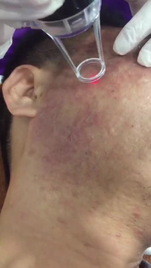 ĐIỀU TRỊ SẸO RỖ BẰNG CÔNG NGHỆ ULTRAPULSE