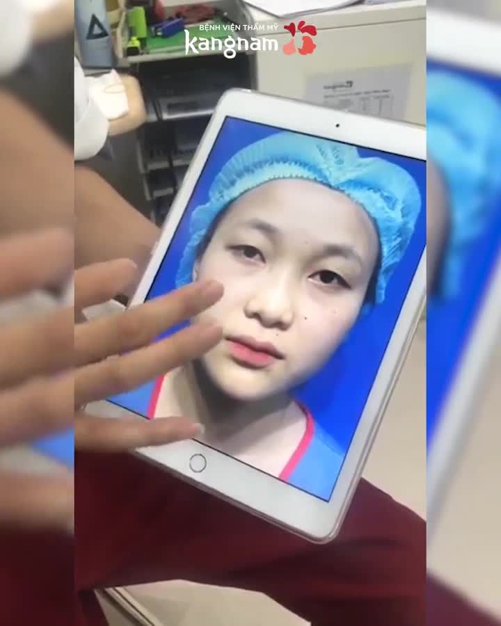 Mắt buồn vì KHÔNG NẾP MÍ - 15p có ngay 2 mí sắc nét