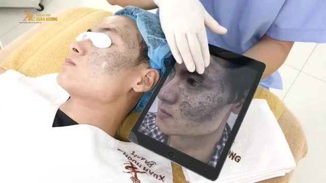 CHÀM BỚT XANH ĐEN PHỦ KÍN KHẮP MẶT 1 LẦN ĐIỀU TRỊ MELAS PICOSURE  MỜ ĐẾN 75%, DA SÁNG VÀ KHỎE MẠNH HƠN