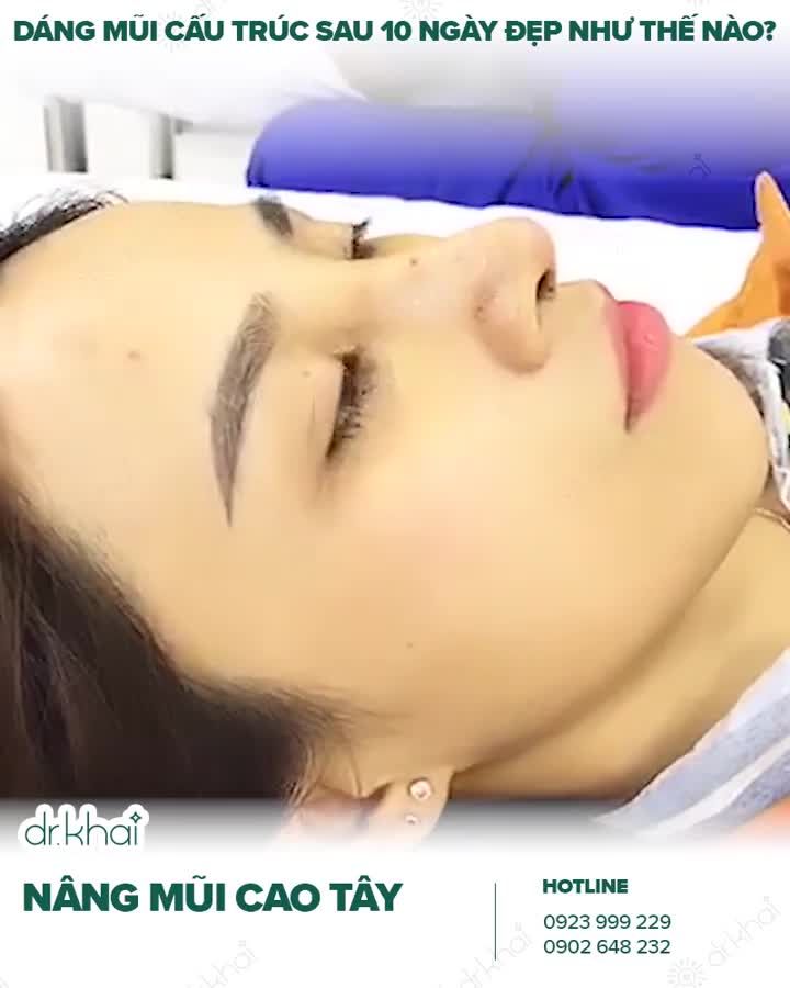 Khách hàng phương xa đến tái khám sau 10 ngày nâng mũi