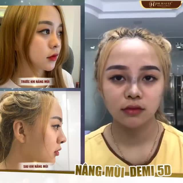 TỰ TI VÌ MŨI NHIỀU KHUYẾT ĐIỂM - ĐẾN DR.HẢI LÊ NGAY NHÉ!!!