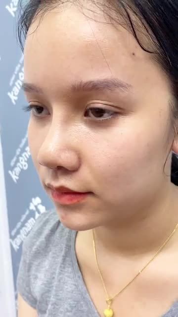Đầu mũi ngắn - lỗ mũi to - Cánh mũi bè Nữ khách hàng người Lào gây ngỡ ngàng với nhan sắc "cực đỉnh" sau 10 ngày Nâng nũi cấu trúc 4D Nanofrom