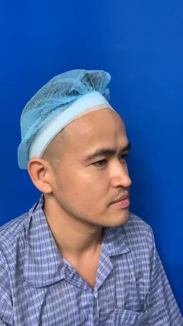 Case khách hàng nam nâng mũi Cấu trúc 4D