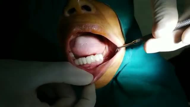 Cấy implant cho khách hàng tại Nha Khoa Thùy Anh.