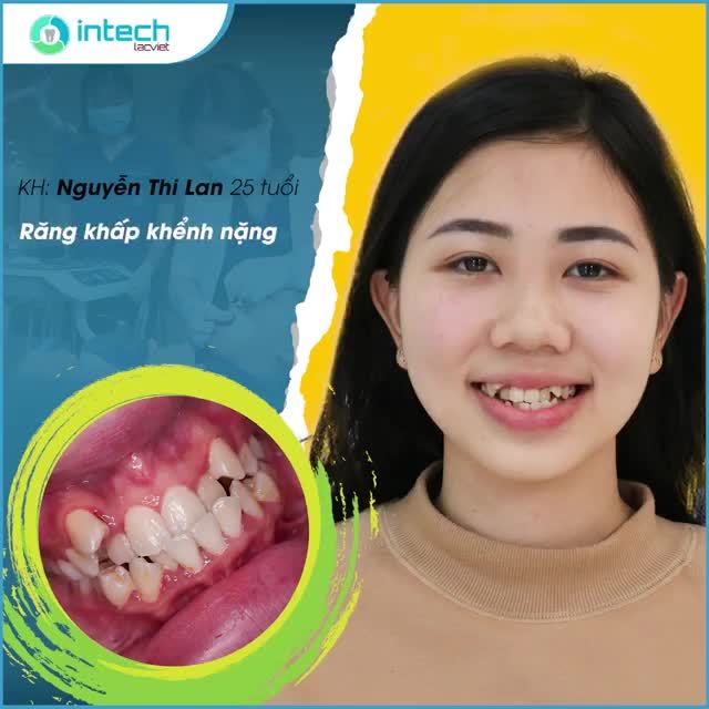 CÔ THIẾU NỮ THIẾU ĐI NỤ CƯỜI TỰ TIN