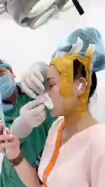 SỬA LẠI CASE MŨI BỌC SỤN KHÔNG NHƯ Ý CHO KHÁCH HÀNG