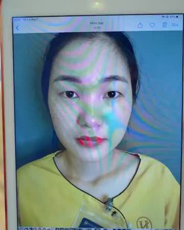 Biến hóa mắt 1 Mí thành 2 MÍ xinh lung linh tại Dr.Hải Lê. Các bạn cùng ngắm nhìn cắt mí của vị khách hàng vừa thực hiện xong