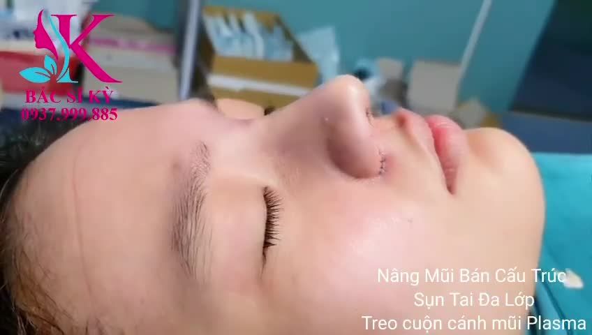 NÂNG MŨI BÁN CẤU TRÚC SỤN TAI ĐA LỚP THU TREO CÁNH MŨI PLASMA