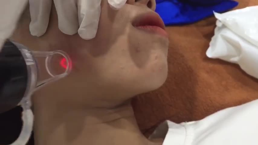 ĐIỀU TRỊ SẸO LỒI VỚI CÔNG NGHỆ ACUPLUSE