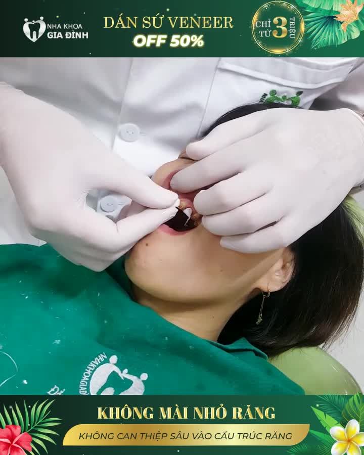 ĐỈNH CAO TRONG THẨM MỸ NỤ CƯỜI CHỈ CÓ THỂ LÀ DÁN SỨ VENEER
