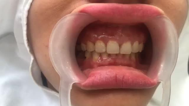 Cắt lợi làm dài thân răng, Vener sứ sau chỉnh nha.