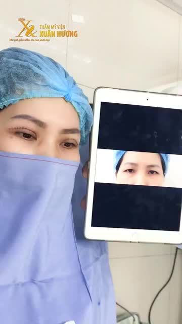 KẾT QUẢ HOÀN HẢO SAU KHI CẮT MÍ MINIDEEP - NẾP MÍ CÂN ĐỐI SẮC NÉT CHỈ 30 PHÚT THỰC HIỆN