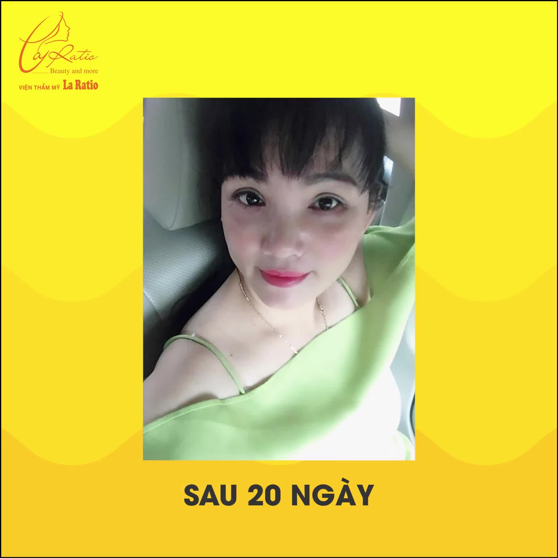 KHẮC PHỤC MẮT MỘT MÍ NHIỀU DA THỪA CÙNG CẮT MÍ ILID