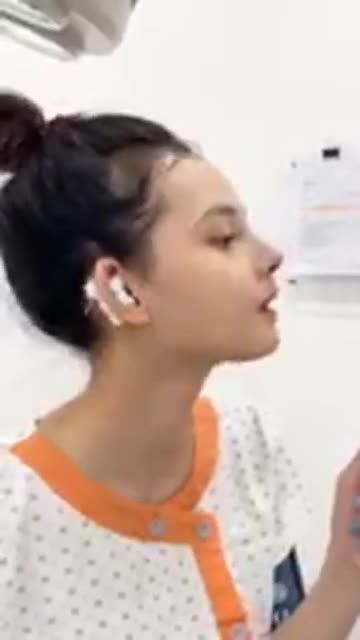 Livestream dáng mũi khách hàng đã từng tiêm filler, sóng mũi ngắn và to, 2 cánh mũi bè.