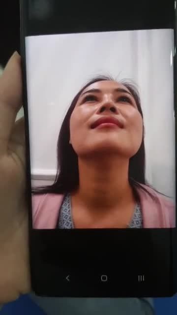 LIVESTREAM TÁI KHÁM NÂNG MŨI NANOFORM SAO 10 NGÀY