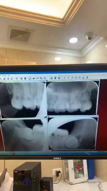 Nhổ 4 răng khôn khó. Trong đó R38 mọc dị dạng ngang ngầm khó trong xương